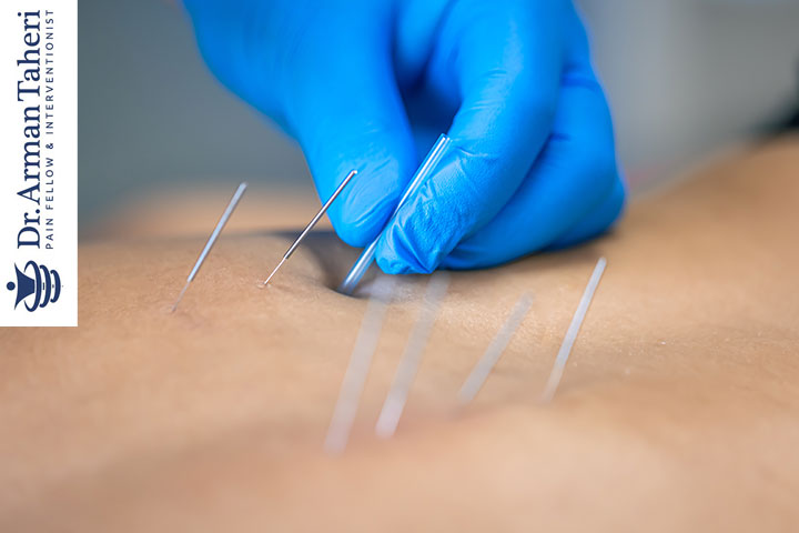 طب سوزنی برای درمان درد کمر