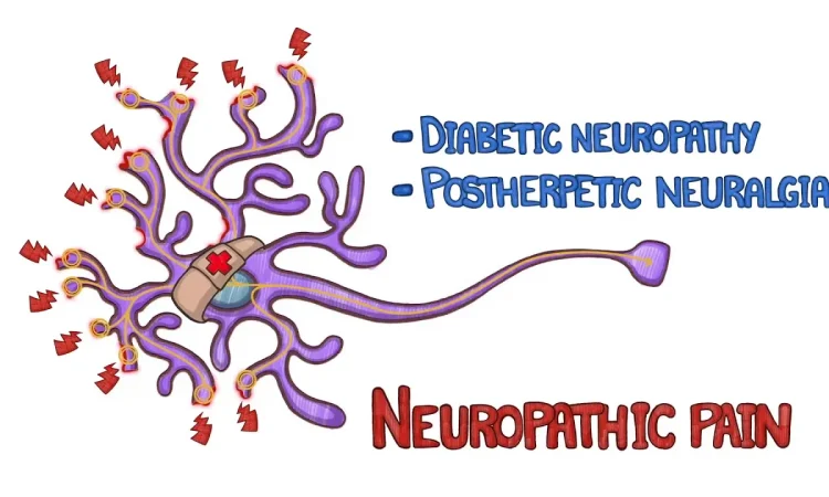 Neuropathic pains 3